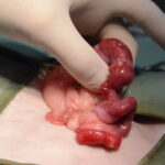 腫瘤形成している子宮