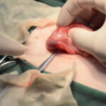 十二指腸に閉塞した異物（豆まきの豆）