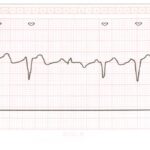2度房室ブロックのECG