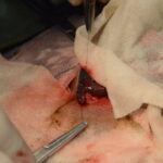壊死部を切除し端々吻合を実施