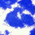 採取された腫瘍細胞