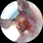 口の中から排膿が確認された(1枚目)