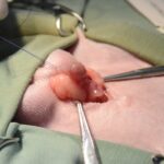 結石を取り除いている様子