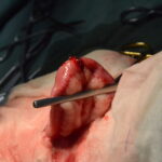 腫瘤切除後の小腸(吸収しで縫合)