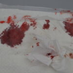 血尿が出ている