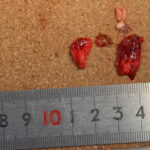 両肺と左肺に詰まっていた膿